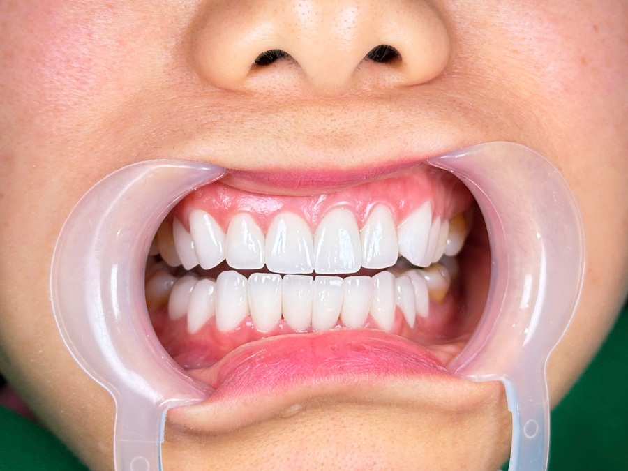 Người đang bọc răng sứ cần lưu ý gì khi ăn uống ngày Tết?
