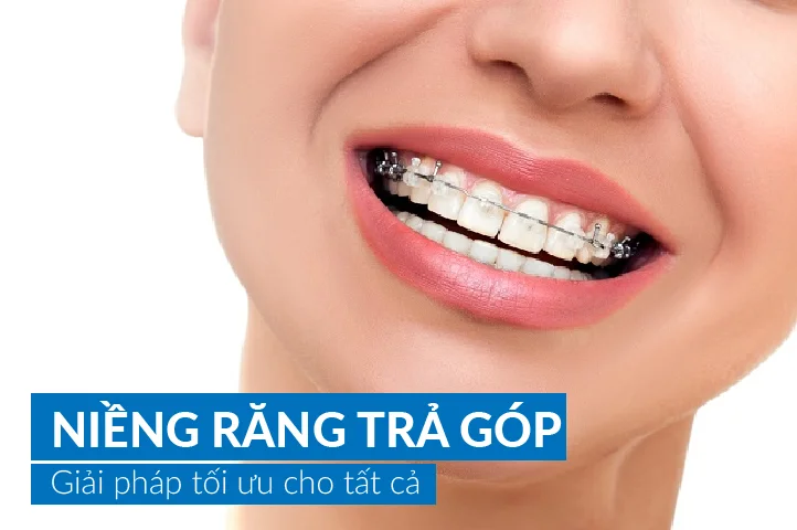 Niềng răng trả góp chỉ từ 1 triệu/tháng: Giải pháp cho sinh viên & người đi làm