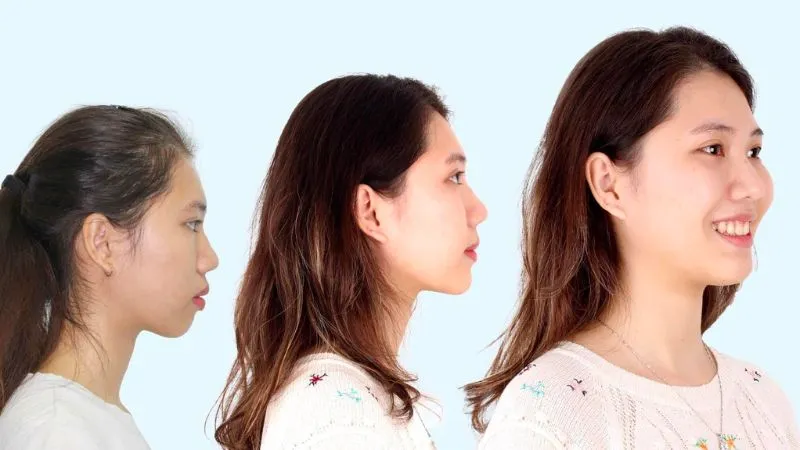 Niềng răng trả góp chỉ từ 1 triệu/tháng: Giải pháp cho sinh viên & người đi làm