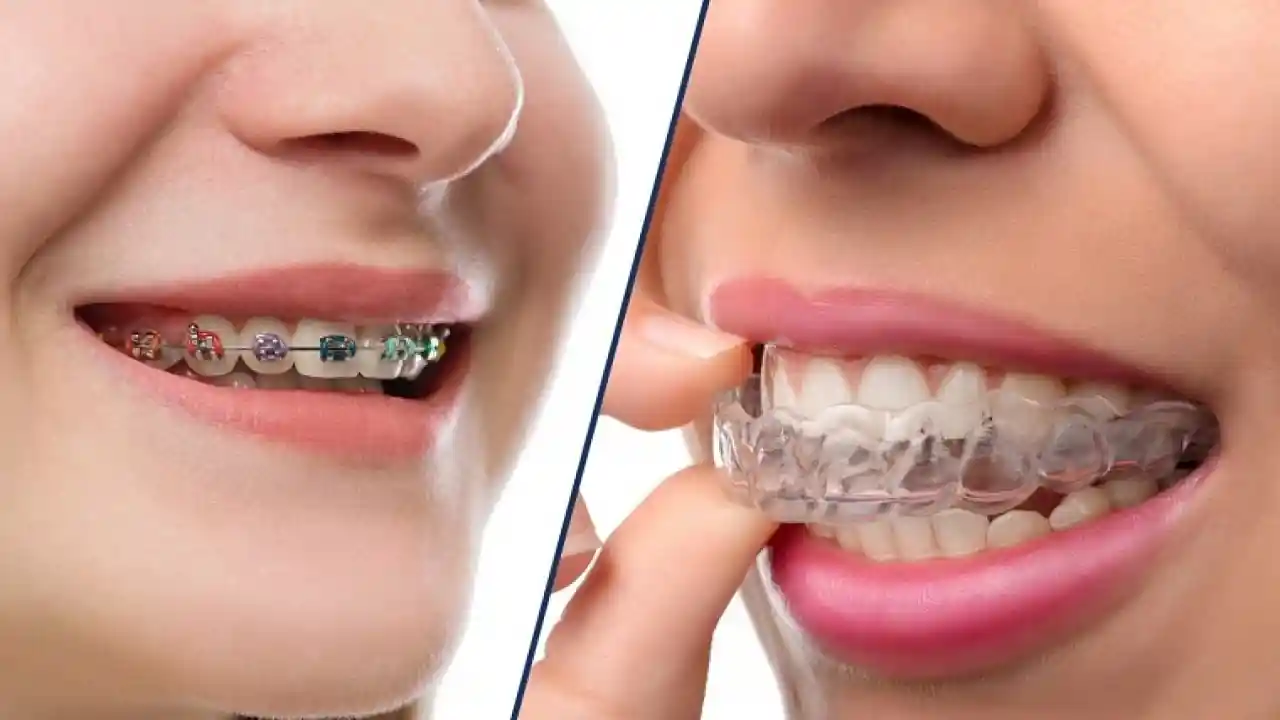 Niềng răng trả góp: chọn kỳ hạn 3/6/9/12 tháng
