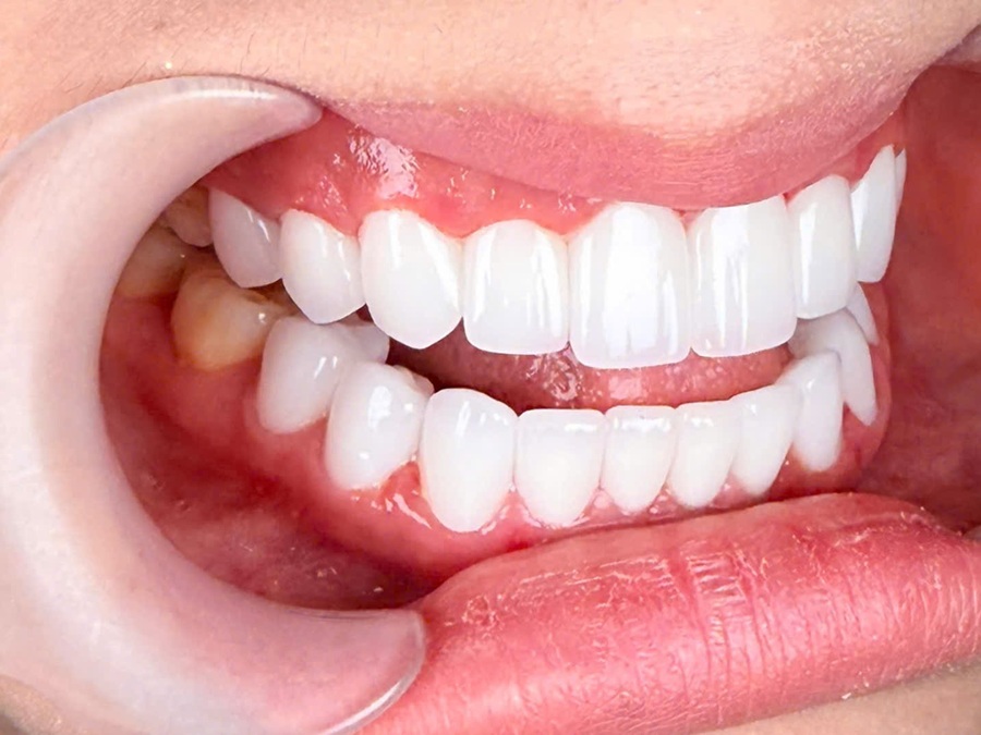 Răng sứ Orodent, Lava Plus, Cercon HT là gì? Tại sao lại đắt?