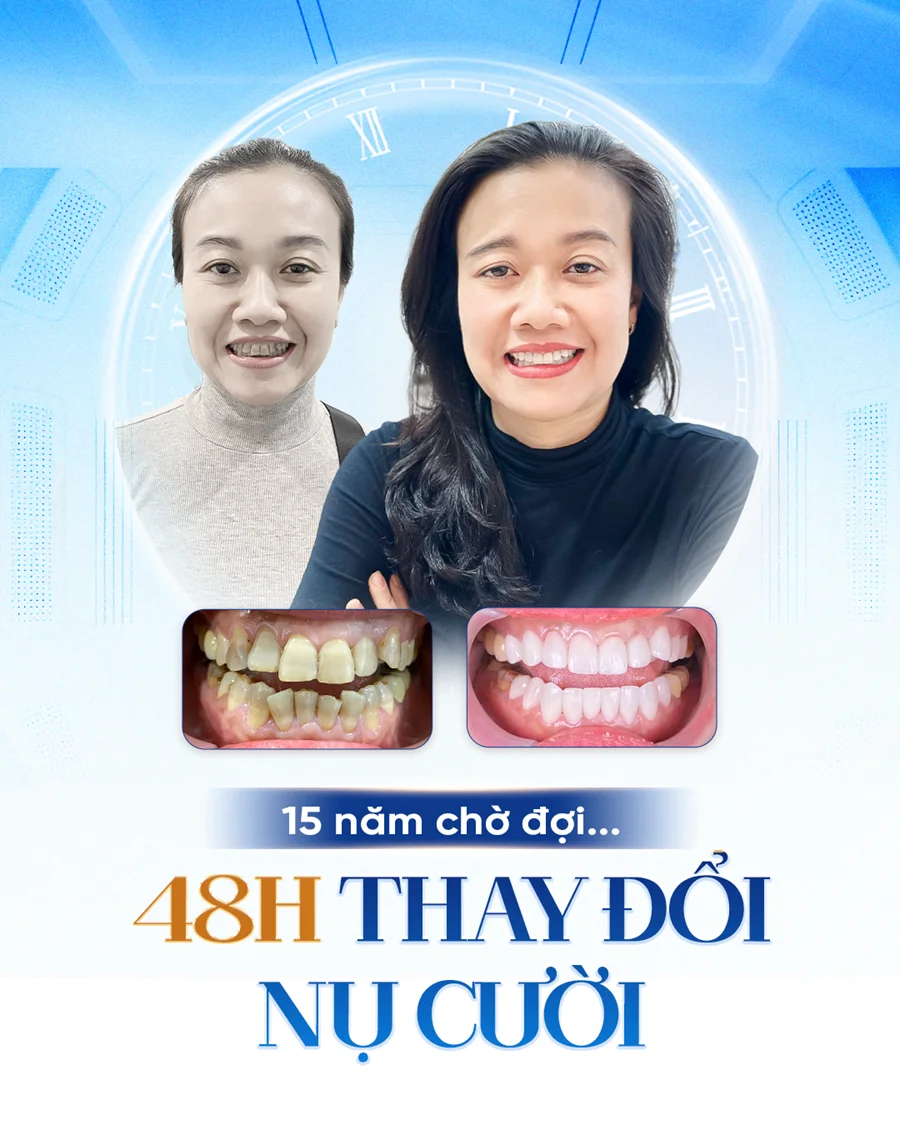 Răng sứ Orodent, Lava Plus, Cercon HT là gì? Tại sao lại đắt?