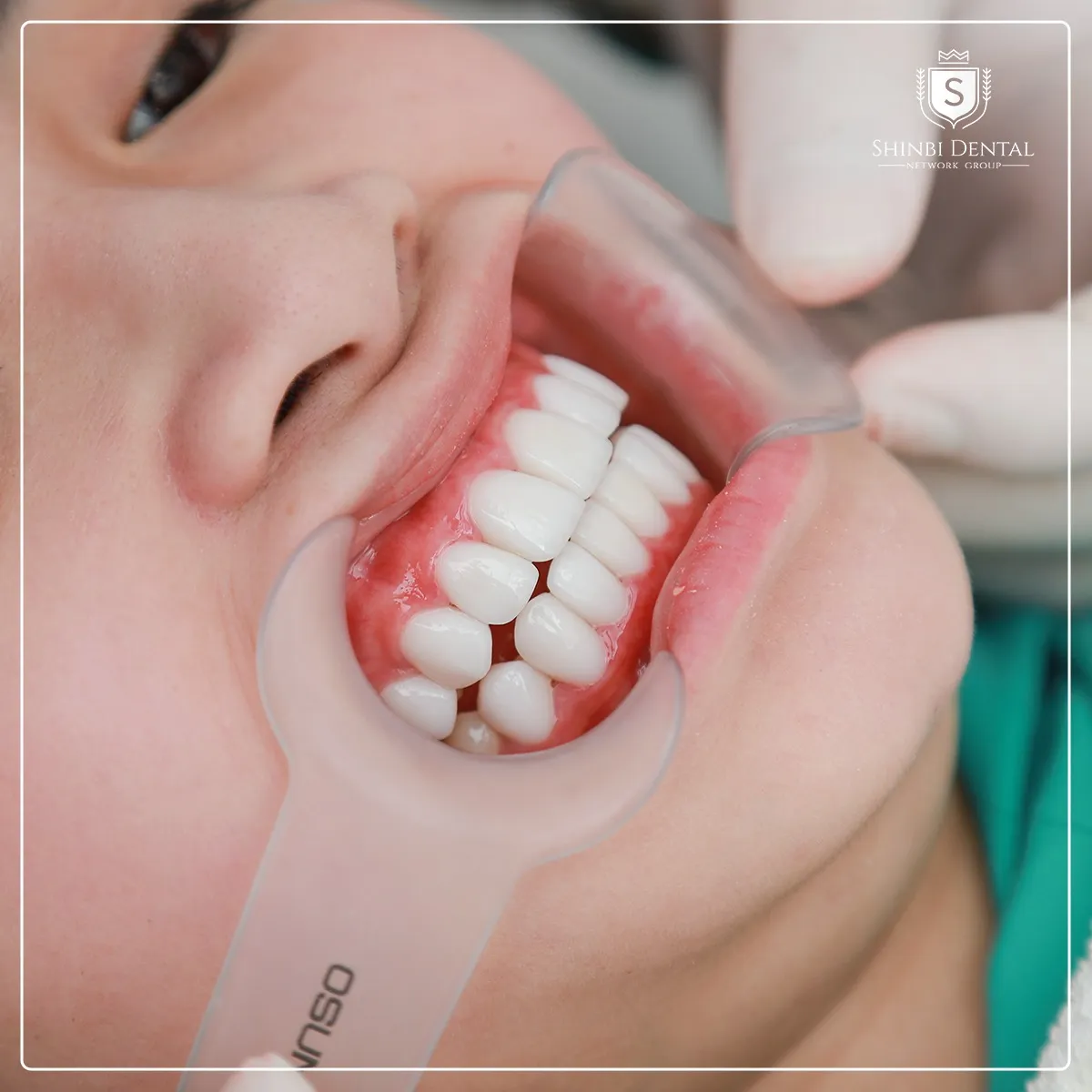 Shinbi Hải Phòng: Ưu đãi làm răng sứ trả góp 0% – Chỉ cần CCCD gắn chíp