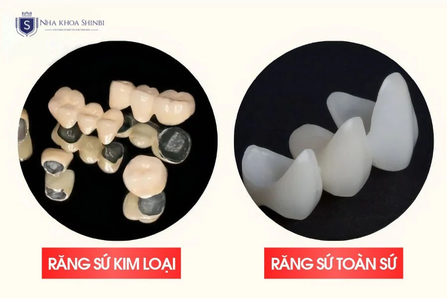 Răng sứ toàn sứ vs sứ kim loại: loại nào bền màu hơn?