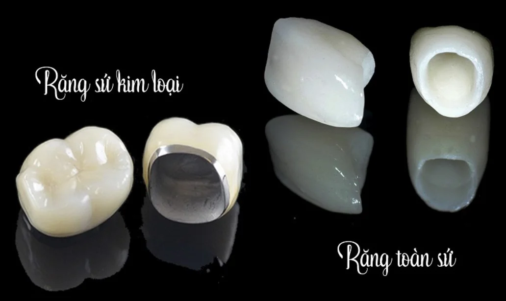 Răng sứ toàn sứ vs sứ kim loại: loại nào bền màu hơn?