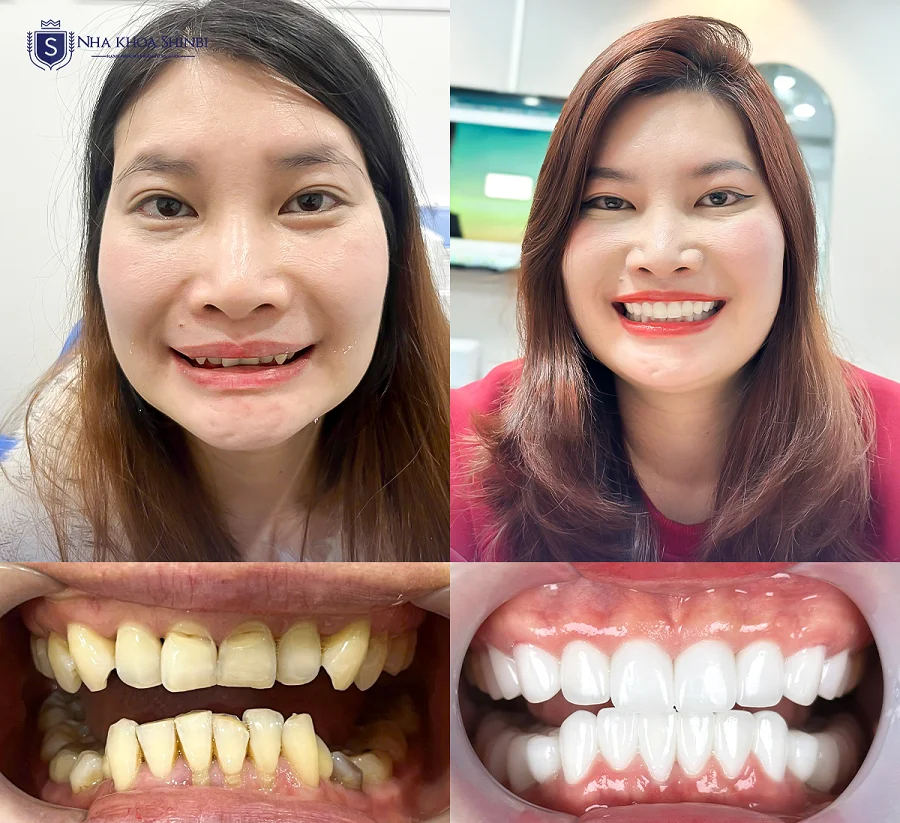 Răng sứ toàn sứ vs sứ kim loại: loại nào bền màu hơn?