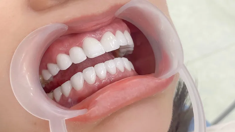 Răng sứ toàn sứ vs sứ kim loại: loại nào bền màu hơn?