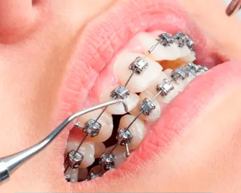 Cách vệ sinh răng khi niềng: tránh sâu răng & bung mắc cài