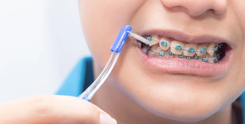 Cách vệ sinh răng khi niềng: tránh sâu răng & bung mắc cài