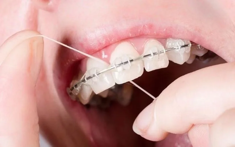 Cách vệ sinh răng khi niềng: tránh sâu răng & bung mắc cài