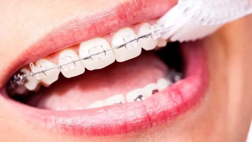 Cách vệ sinh răng khi niềng: tránh sâu răng & bung mắc cài