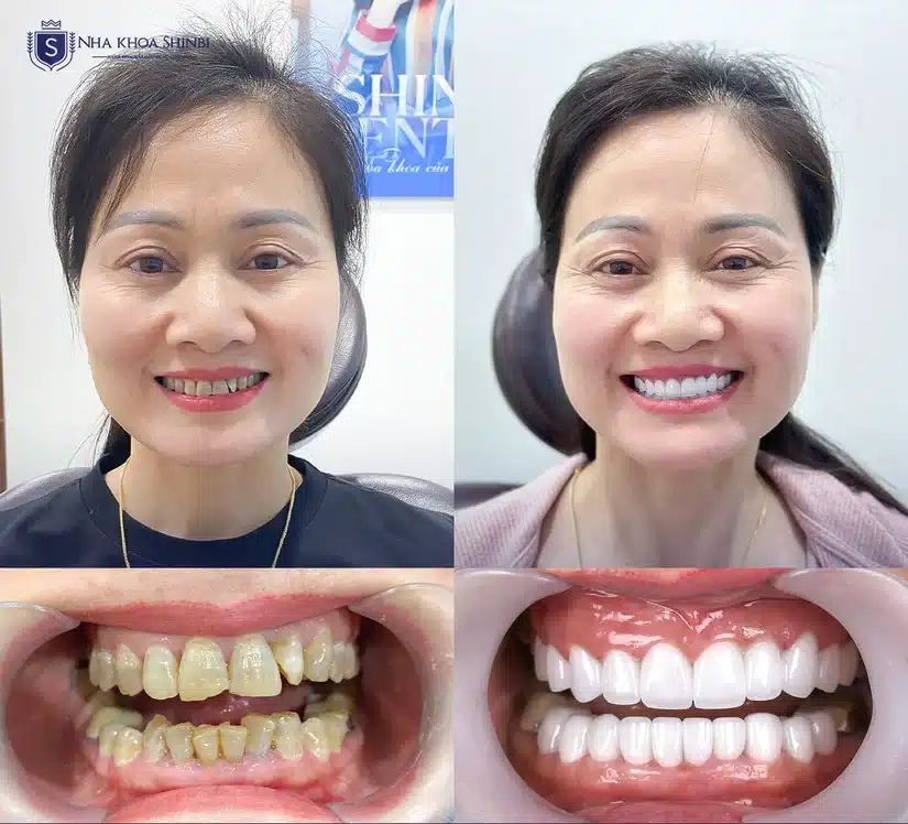 Chính sách tài chính làm răng sứ tại Shinbi có gì khác biệt?