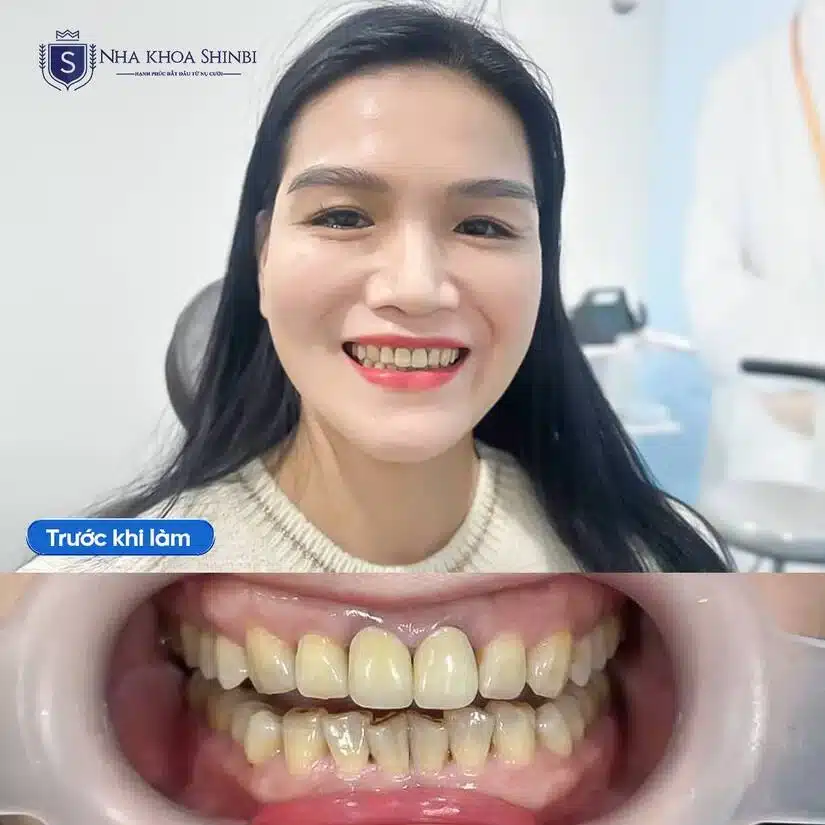 Chính sách tài chính làm răng sứ tại Shinbi có gì khác biệt?