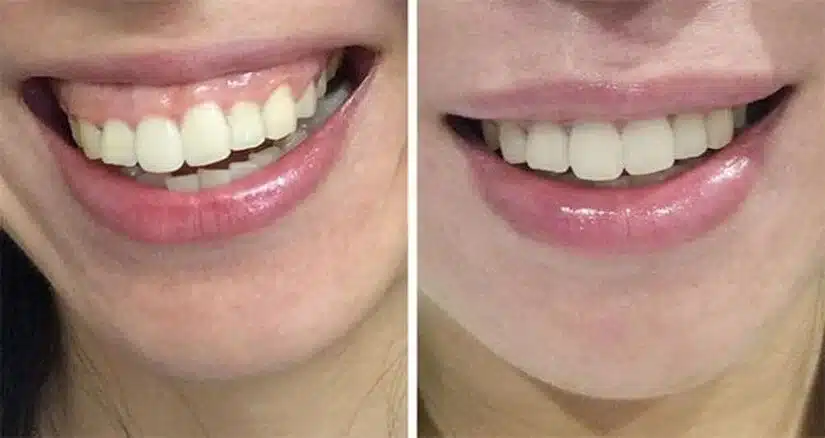 Cười hở lợi khiến nhiều người ngại cười thật sự trong giao tiếp hằng ngày. Khi tìm kiếm “điều trị cười hở lợi gần đây”, phần lớn đều muốn một địa chỉ ở trung tâm Hà Nội - dễ di chuyển - tư vấn rõ ràng và an toàn. Vậy, đâu là điểm đến đáng tin cậy? Cười hở lợi là gì? Khi nào nên can thiệp? Cười hở lợi thường được hiểu đơn giản là khi bạn cười, phần lợi lộ ra nhiều hơn mức mong muốn, khiến tổng thể nụ cười kém cân đối so với môi - răng - khuôn mặt. Thực tế, mức độ “hở lợi” không có một con số tuyệt đối cho tất cả mọi người. Có người thấy bình thường, nhưng cũng có người cảm thấy mất tự tin rõ rệt khi chụp ảnh hoặc giao tiếp gần. Hình ảnh cười hở lợi Khi nào nên cân nhắc tư vấn? Bạn cảm thấy nụ cười thiếu hài hòa, ảnh hưởng đến sự tự tin Tình trạng này xuất hiện lâu dài và bạn muốn cải thiện về mặt thẩm mỹ Bạn chuẩn bị cho những dịp quan trọng (chụp ảnh, công việc, sự kiện cá nhân) Cần lưu ý rằng, cười hở lợi không phải chỉ có một nguyên nhân duy nhất. Có thể đến từ cơ môi, nướu, răng hoặc khớp cắn. Vì vậy, việc thăm khám để xác định đúng nguyên nhân là bước bắt buộc trước khi đưa ra hướng xử lý phù hợp. Điều trị cười hở lợi có những hướng nào? Không có một phương án chung cho tất cả các trường hợp cười hở lợi. Việc lựa chọn cách điều trị phụ thuộc trực tiếp vào nguyên nhân cụ thể và trong nhiều trường hợp, bác sĩ có thể cần kết hợp nhiều hướng can thiệp để đạt được sự hài hòa tổng thể. Hiểu ở mức tổng quan sẽ giúp bạn biết mình đang được tư vấn theo “logic nguyên nhân”, thay vì chọn giải pháp theo cảm tính. Nguyên nhân Biểu hiện thường gặp Hướng xử lý (tổng quan) Mục tiêu cải thiện Cơ môi nâng môi trên hoạt động mạnh Khi cười, môi trên kéo lên cao, lộ lợi nhiều Điều chỉnh hoạt động cơ môi (can thiệp thẩm mỹ phù hợp) Giảm độ nâng môi khi cười Nướu phát triển nhiều (lợi dày) Thân răng nhìn ngắn, lợi che phủ nhiều Tạo hình nướu thẩm mỹ Làm lộ thân răng cân đối hơn Răng ngắn / hình thể răng chưa cân đối Răng nhỏ, không tương xứng với lợi Điều chỉnh hình thể răng (phục hình thẩm mỹ) Cân đối tỷ lệ răng - lợi Sai lệch khớp cắn / xương hàm Cười hở lợi kèm sai khớp cắn, khuôn mặt thiếu cân đối Chỉnh nha hoặc can thiệp chuyên sâu hơn (nếu cần) Cải thiện tổng thể nụ cười và cấu trúc hàm Các phương pháp điều chỉnh cười hở lợi Trong thực tế, nhiều trường hợp không nằm hoàn toàn ở một nhóm nguyên nhân mà có thể là sự kết hợp. Vì vậy, việc thăm khám trực tiếp và đánh giá cá nhân hóa luôn là bước quan trọng trước khi quyết định điều trị. Tùy thuộc vào mức độ hở lợi, các bác sĩ sẽ chỉ định phương pháp điều trị phù hợp Tiêu chí chọn địa chỉ điều trị cười hở lợi “uy tín” tại trung tâm Hà Nội Khi tìm kiếm một địa chỉ “gần đây”, yếu tố khoảng cách là cần thiết, nhưng chưa đủ. Điều quan trọng hơn là nơi đó có đánh giá đúng nguyên nhân - tư vấn đúng hướng - và đồng hành đủ dài trong suốt quá trình điều trị. ➦ Đánh giá nguyên nhân trước khi đề xuất phương án Một cơ sở uy tín sẽ không đưa ra giải pháp ngay từ đầu, mà cần bước thăm khám để xác định rõ nguyên nhân: do cơ môi, nướu hay khớp cắn. Đây là nền tảng để tránh điều trị sai hướng - vừa tốn chi phí, vừa không đạt kết quả như kỳ vọng. ➦ Tư vấn trung thực về mức độ cải thiện Không phải trường hợp nào cũng “thay đổi hoàn toàn” sau can thiệp. Những đơn vị chuyên sâu sẽ tư vấn rõ: cải thiện ở mức nào, cần kết hợp gì thêm, và kết quả có phù hợp với mong muốn ban đầu hay không. ➦ Phác đồ rõ ràng - có lộ trình theo dõi Một kế hoạch điều trị bài bản không chỉ dừng ở bước thực hiện, mà còn bao gồm hướng chăm sóc sau đó và lịch tái khám. Điều này đặc biệt quan trọng với người bận rộn, cần chủ động thời gian. ➦ Vị trí trung tâm - thuận tiện duy trì lịch hẹn Với người làm việc tại khu vực trung tâm Hà Nội, yếu tố “gần - dễ đi - dễ quay lại” giúp việc điều trị không bị gián đoạn. Đây là lý do nhiều người ưu tiên các phòng khám nằm tại khu vực lõi nội đô. Điều trị cười hở lợi “gần đây” tại trung tâm Hà Nội: nên đặt lịch tư vấn khi nào? Không cần đợi đến khi tình trạng trở nên “nghiêm trọng”, việc đi tư vấn sớm giúp bạn hiểu rõ mình đang ở mức nào và có những lựa chọn gì phù hợp. ⤷ Khi bạn muốn cải thiện nụ cười để tự tin hơn Nếu bạn thường xuyên ngại cười lớn, né góc chụp ảnh hoặc cảm thấy nụ cười chưa hài hòa, đó là dấu hiệu nên đi kiểm tra. Đôi khi chỉ cần điều chỉnh nhẹ cũng đã tạo khác biệt rõ rệt. Địa chỉ uy tín tại trung tâm Hà Nội được đông đảo khách hàng lựa chọn ⤷ Khi có kế hoạch cho sự kiện quan trọng Các mốc như cưới, chụp ảnh, thay đổi công việc… là thời điểm nhiều người bắt đầu quan tâm đến thẩm mỹ nụ cười. Việc tư vấn sớm giúp bạn chủ động thời gian và lựa chọn phương án phù hợp tiến độ. ⤷ Khi bạn đã tìm hiểu nhưng chưa rõ nguyên nhân Rất nhiều người đã đọc nhiều thông tin nhưng vẫn chưa biết mình thuộc nhóm nào. Thăm khám trực tiếp sẽ giúp “chốt lại” vấn đề, tránh việc tự suy đoán sai và chọn nhầm phương pháp. → ĐẶT LỊCH NGAY ← để được trò chuyện trực tiếp với chuyên gia, sắp xếp 1 buổi thăm khám nhanh chóng - hiệu quả và tiết kiệm nhất!