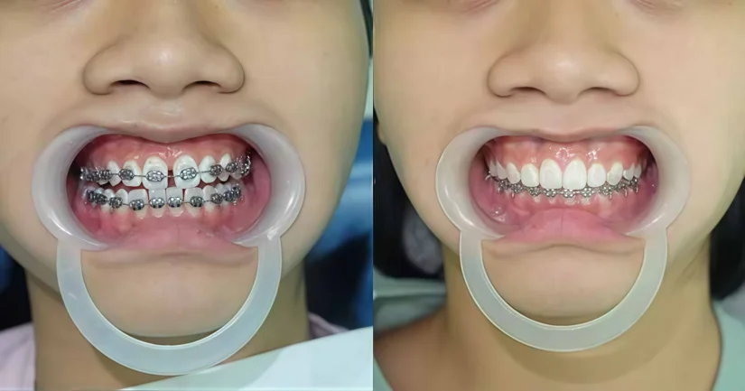 Làm răng trả góp: Mọi điều bạn cần biết trước khi thực hiện