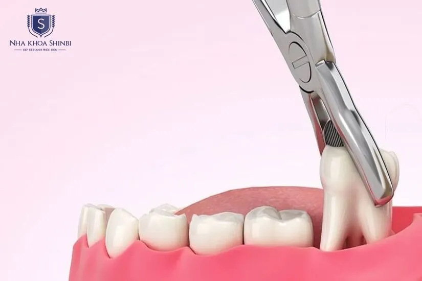 Nhổ răng khôn gần đây: Địa chỉ không đau, uy tín tại 33 Trần Quốc Toản