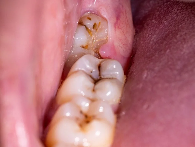 Nhổ răng khôn gần đây: Địa chỉ không đau, uy tín tại 33 Trần Quốc Toản