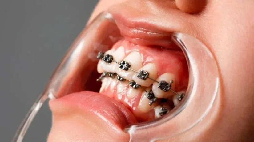Niềng răng bao lâu thì đẹp? Mốc thời gian thay đổi theo từng giai đoạn
