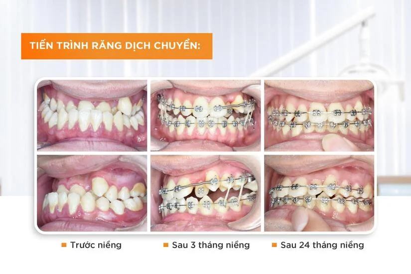 Niềng răng bao lâu thì đẹp? Mốc thời gian thay đổi theo từng giai đoạn