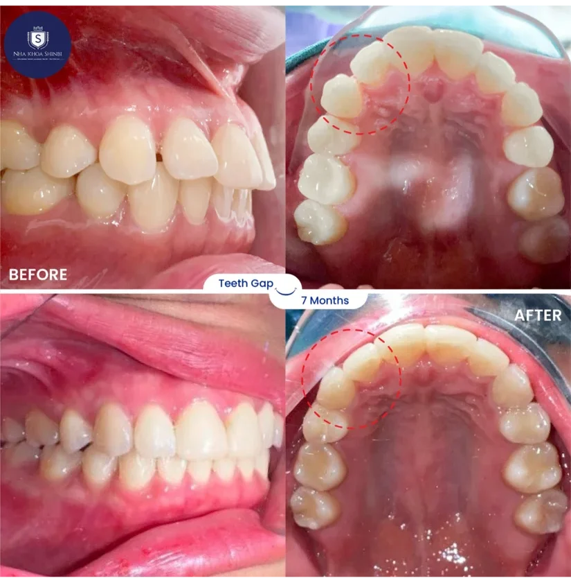 Niềng răng bao lâu thì đẹp? Mốc thời gian thay đổi theo từng giai đoạn