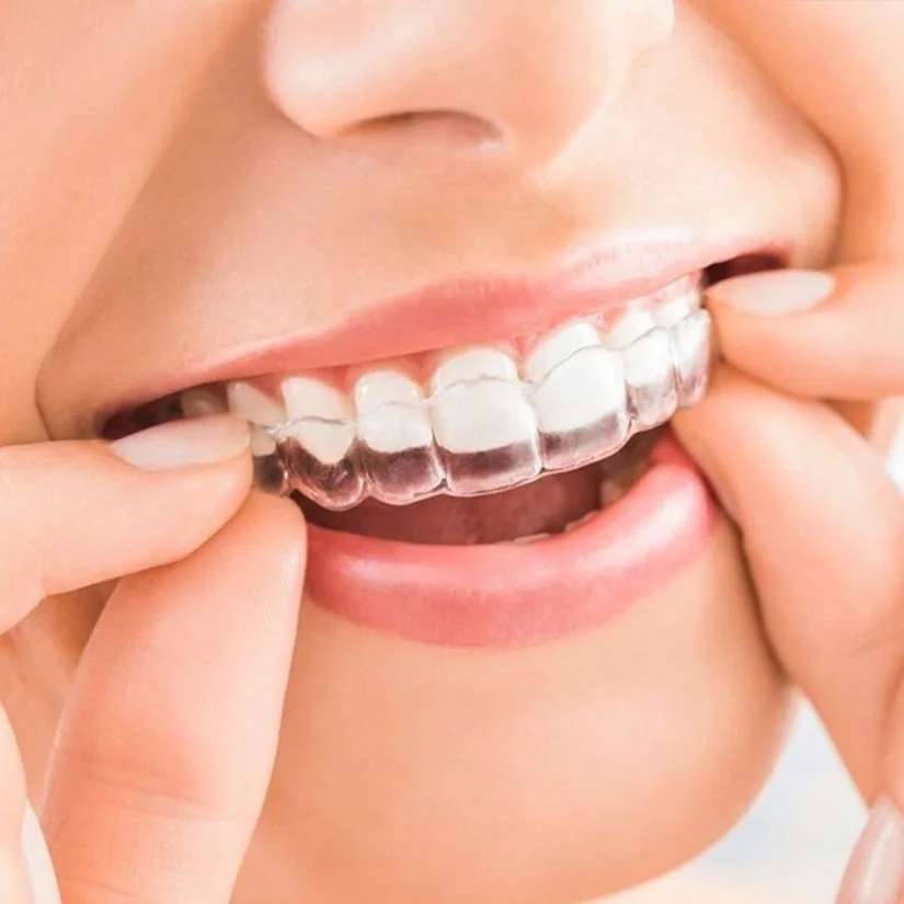 Niềng răng không mắc cài: áp dụng khi nào? Có thực sự hiệu quả?