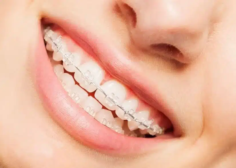 Niềng răng mắc cài sứ: ưu nhược điểm & mức giá cập nhật