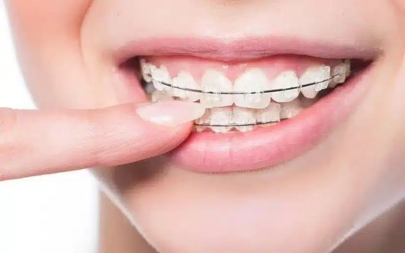 Niềng răng mắc cài sứ: ưu nhược điểm & mức giá cập nhật