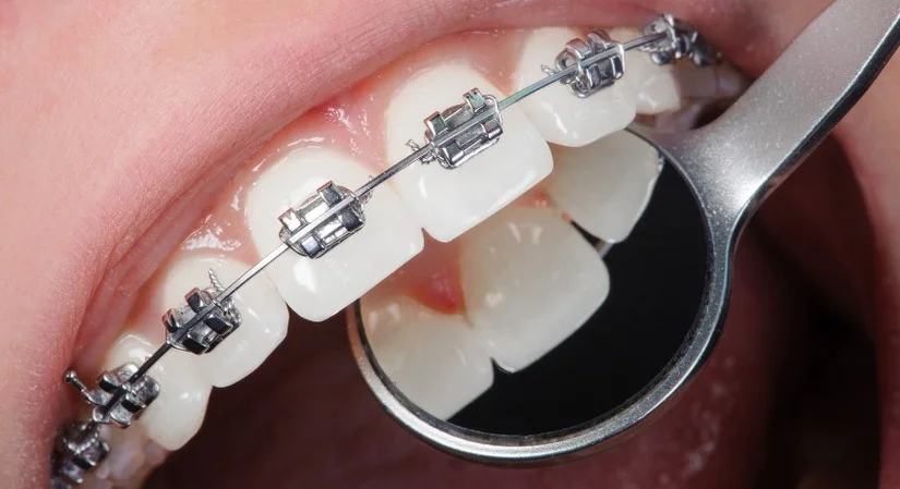 Niềng răng mắc cài tự buộc khác gì mắc cài thường?