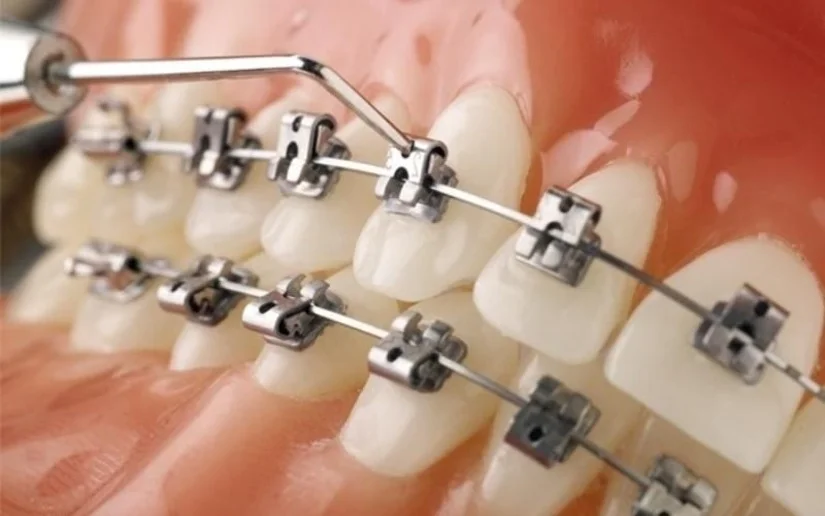 Niềng răng mắc cài tự buộc khác gì mắc cài thường?