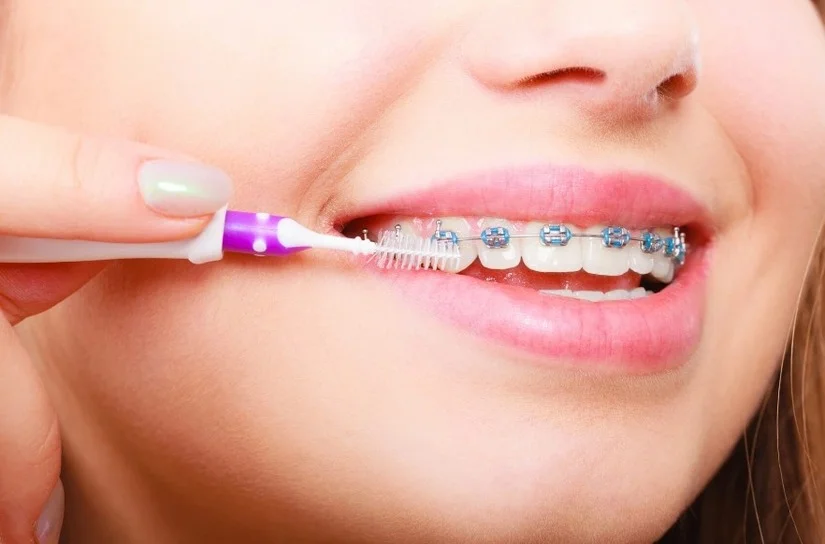 Niềng răng ăn gì? Thực đơn 14 ngày đầu cho người niềng răng