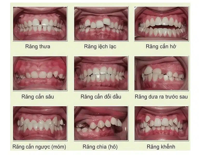 Niềng răng thẩm mỹ: Hành trình thay đổi khuôn mặt và nụ cười