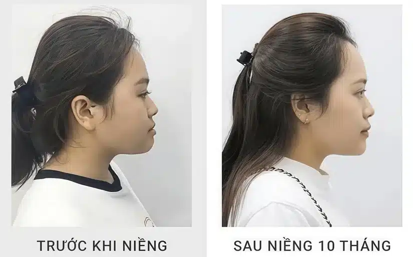 Niềng răng thẩm mỹ: Hành trình thay đổi khuôn mặt và nụ cười