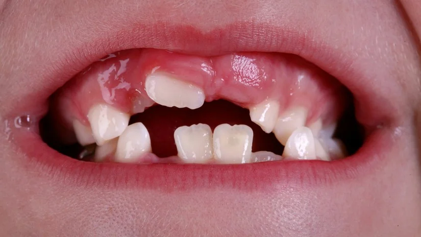 Nói ngọng nhẹ sau thay răng sữa nên kiểm tra ở đâu tại Hà Nội