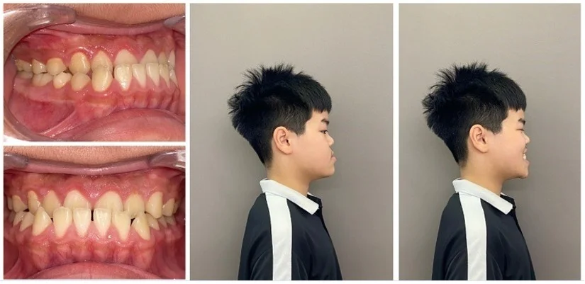Răng móm làm mặt bị gãy nên thăm khám chỉnh nha tại đâu gần Long Biên