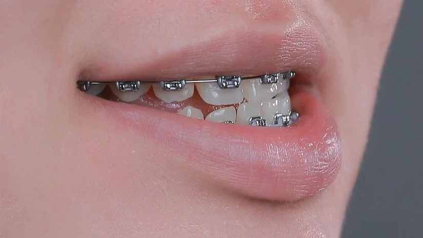 Răng móm làm mặt bị gãy nên thăm khám chỉnh nha tại đâu gần Long Biên