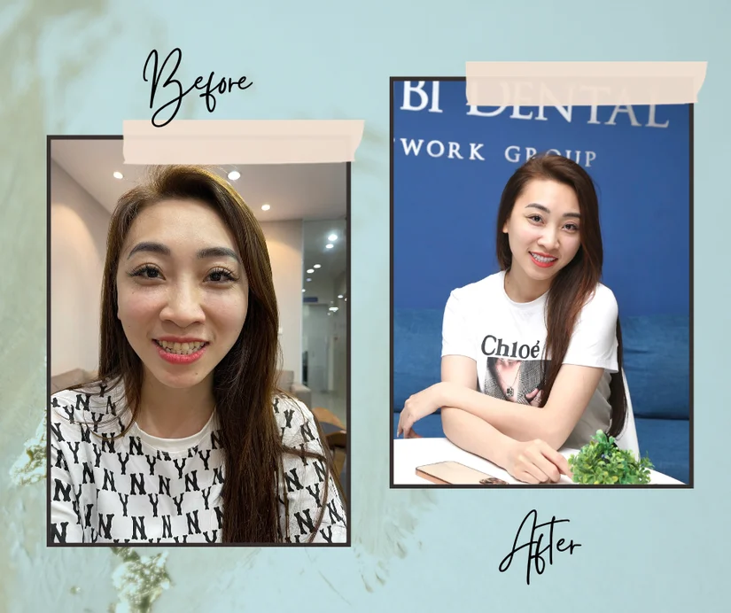 Tìm nha khoa dán sứ Veneer gần ngã tư Bà Triệu - Tuệ Tĩnh