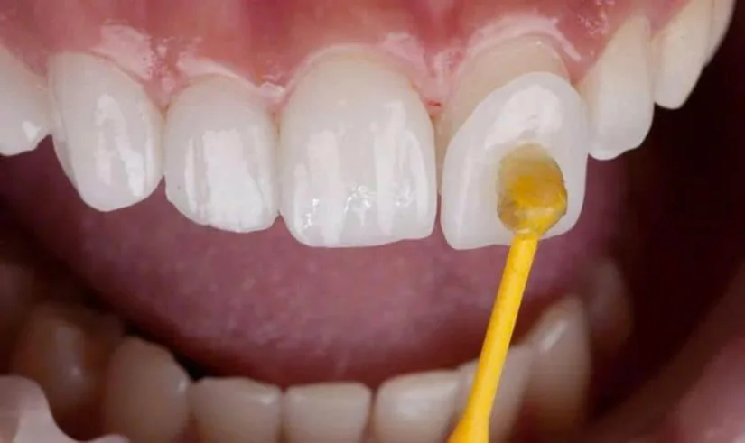 Tìm nha khoa dán sứ Veneer gần ngã tư Bà Triệu - Tuệ Tĩnh