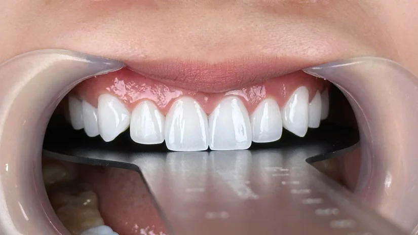 Tìm nha khoa dán sứ Veneer gần ngã tư Bà Triệu - Tuệ Tĩnh