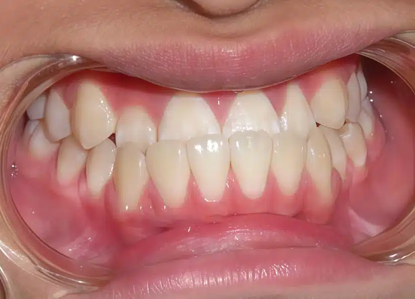 Niềng răng móm: phương pháp phù hợp cho từng mức độ