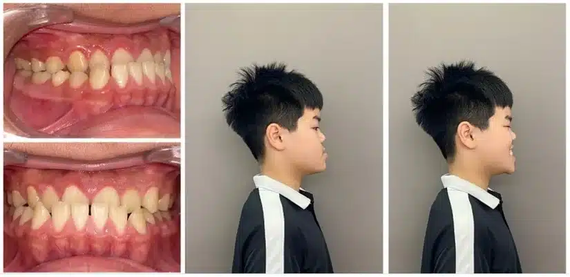 Niềng răng móm: phương pháp phù hợp cho từng mức độ
