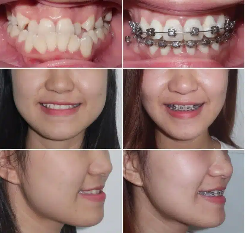 Niềng răng móm: phương pháp phù hợp cho từng mức độ