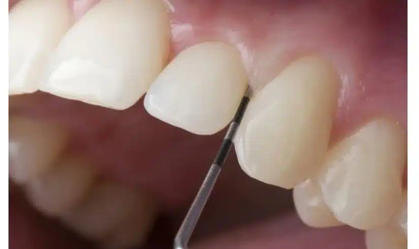 Răng sứ bị cộm, cấn – Dấu hiệu sai kỹ thuật