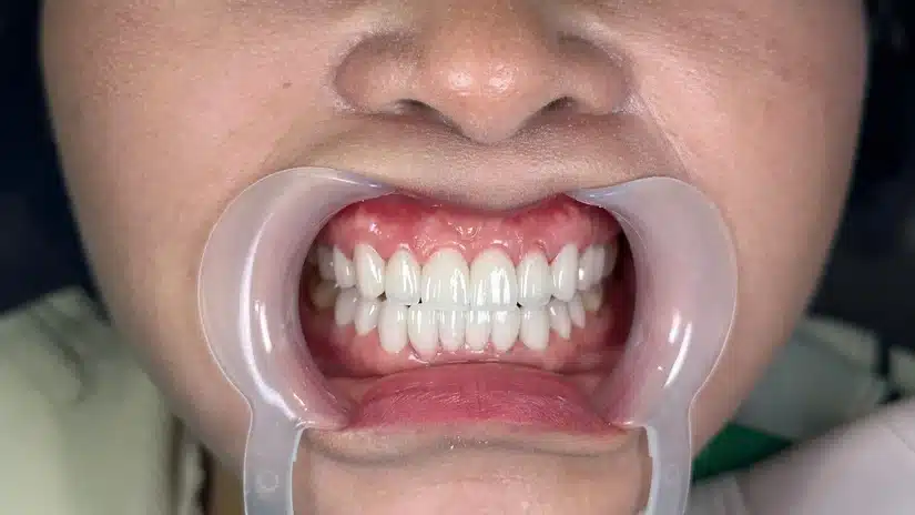Răng sứ bị cộm, cấn – Dấu hiệu sai kỹ thuật