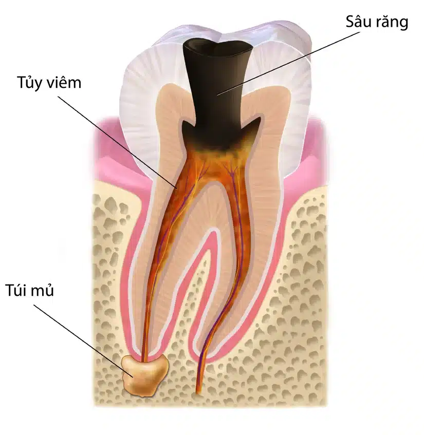 Viêm tủy răng có nguy hiểm không? 7 dấu hiệu cần biết