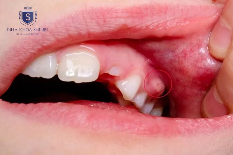 Áp xe răng gồm quanh chóp và nha chu với nguyên nhân và điều trị khác nhau
