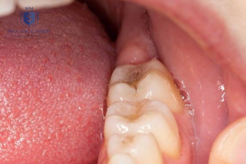 Áp xe răng hàm gây đau lan dễ nhầm bệnh và có nguy cơ biến chứng xoang hàm