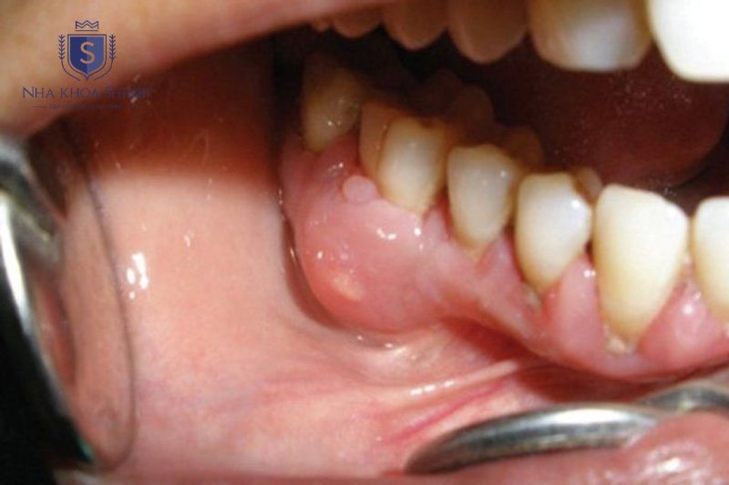 Áp xe răng hàm không luôn cần nhổ nếu còn khả năng phục hồi bằng điều trị tủy