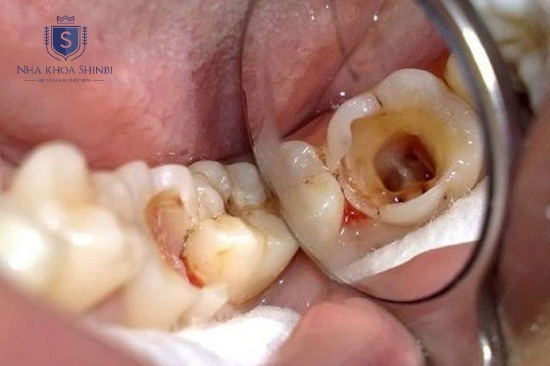 Áp xe răng hình thành từ sâu răng viêm nha chu chấn thương hoặc điều trị tủy không triệt để
