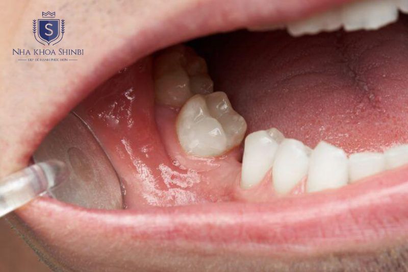 Áp xe răng không điều trị có thể gây biến chứng từ tiêu xương đến nhiễm trùng toàn thân