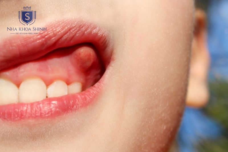 Áp xe răng tiến triển từ đau nhức sưng đỏ đến hình thành ổ mủ và sốt nhiễm trùng